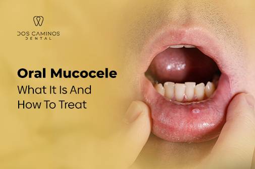 Mucous Cyst Lip Pictures Treatment