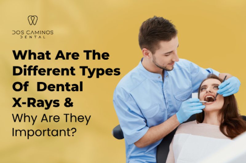 Different Types of Dental X-Rays